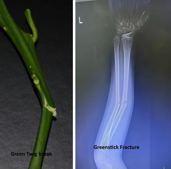 GreenStick Fracture