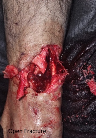 Open Fracture